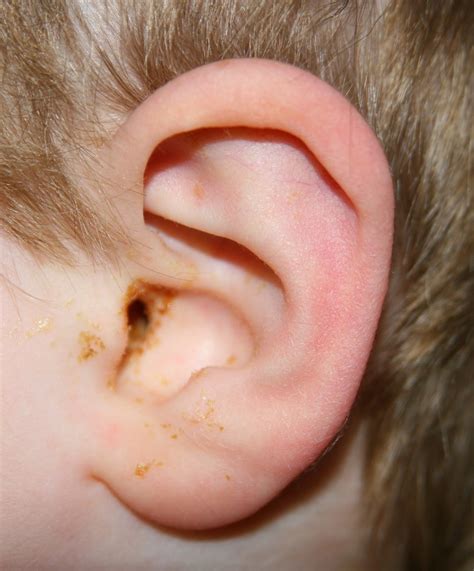 ear damage